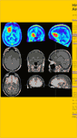Mobile Screenshot of hirntumor.net